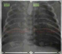 Pneumothorax | R�ntgenfoto: A.D.A.M.